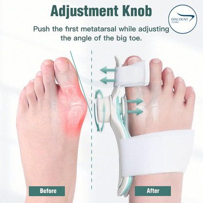 Pain Relief Bunion Toe Corrector - (IMPORTED W/ KNOB)